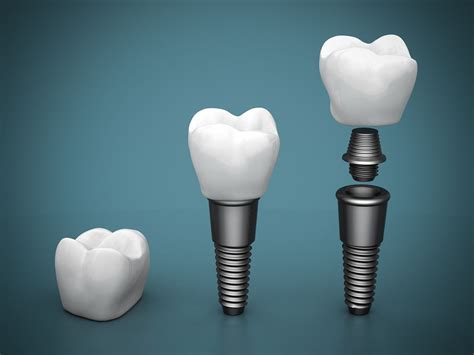 Oral Surgery and Dental Implants 